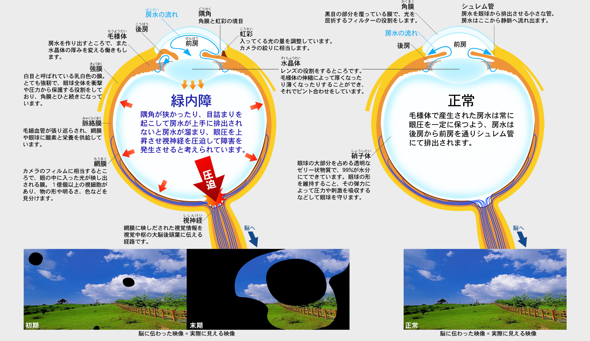 糖尿病により他の目の問題のリスクが高まる可能性がありますか?